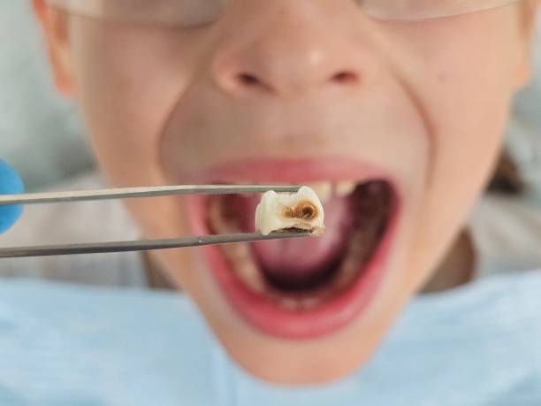 Best Emergency Tooth Extraction in Aberdeen, NC